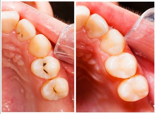 11 nemme måder, at forebygge huller i tænderne