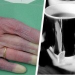 Kolde hænder: Mulige årsager du bør kende