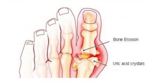 Urinsyre i storetaaen