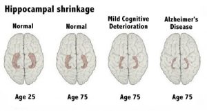 Lær at genkende de tidlige tegn på alzheimers