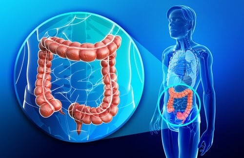 Colitis Ulcerosa