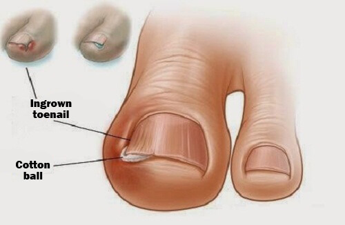 Behandling af indgroet taanegl