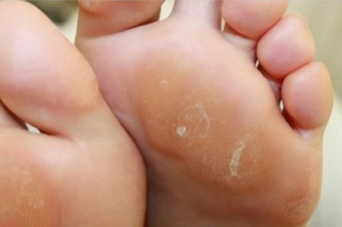 Naturlig fodcreme imod hård hud