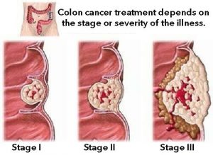 Hjemmebehandling for colitis ulcerosa