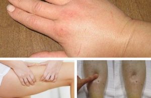 Otte vanddrivende midler mod væskeophobning