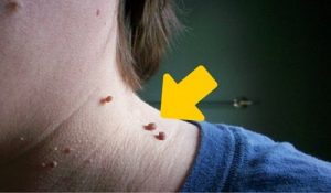Prøv disse 6 tips til at fjerne skin tags naturligt
