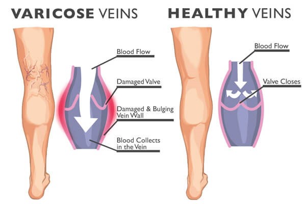 Åreknuder og karsprængninger er hævede blodkar, bl.a. i benene