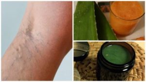 Din bedstemors behandling af åreknuder