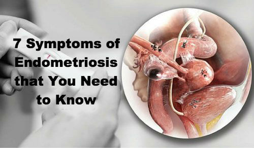 7 symptomer på endometriose som man bør kende