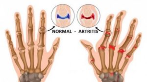5 ting du garanteret ikke vidste om leddegigt