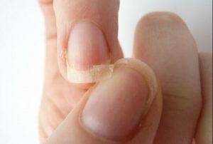 7 naturlige metoder til at styrke flossede negle