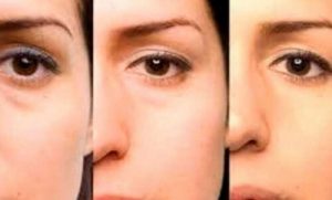 Råd til at fjerne poser under øjnene