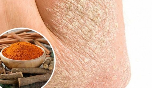 7 naturlige måder at bekæmpe hudsygdommen psoriasis