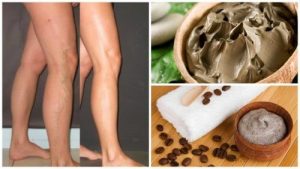 5 naturlige måder at bekæmpe åreknuder
