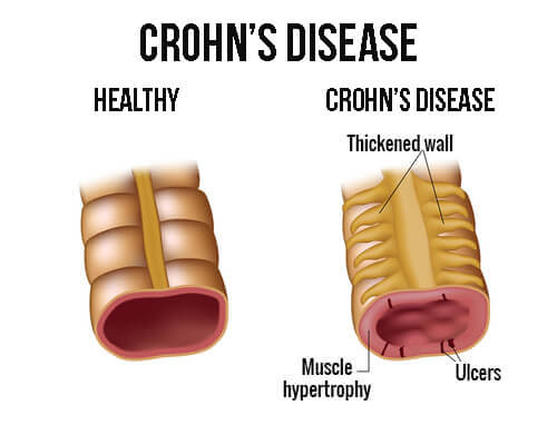 Behandling af Crohns sygdom med den rigtige kost