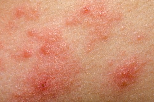 dermatitis og sart hud