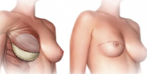 Det bør du vide før en mastektomi