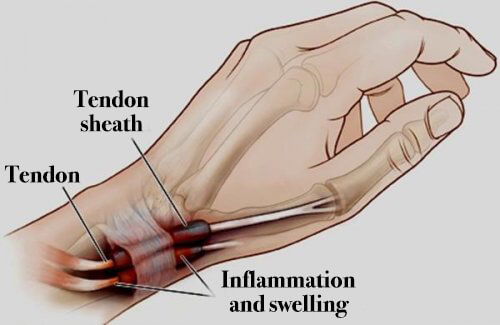 Seneskedehindebetændelse: Inflammation i hænderne og fødderne