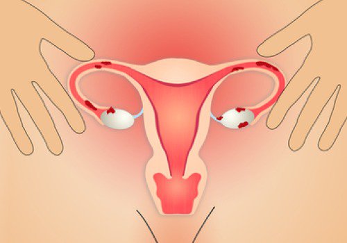 Har du smerter i underlivet? Så lider du måske af endometriose.