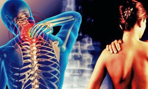 Cervikobrakialt syndrom: Smerte fra nakken ned i armene
