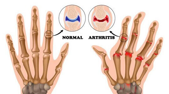 Tegning over gigt i fingrene