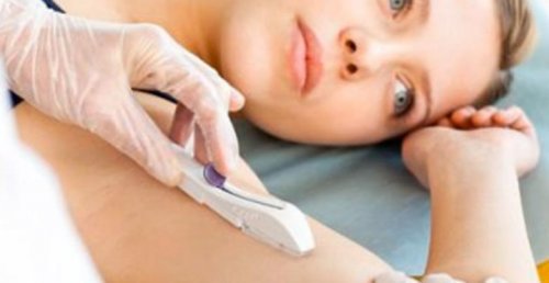 P-stave er hormonbehandlende og sættes ind under huden ved lokalbedøvelse.