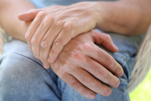 Hjemmemidler til at behandle vitiligo