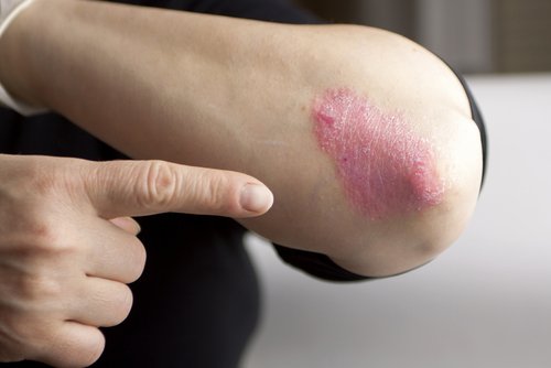 Person med psoriasis paa albuen