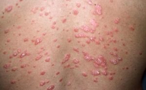 Hvad er psoriasis, og hvad er de forskellige former?