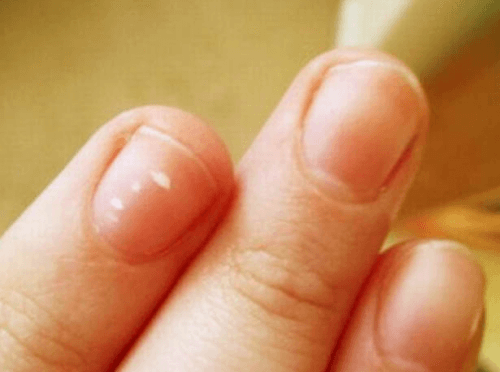fingernegle