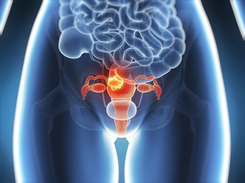 6 symptomer på livmoderhalskræft, som man bør kende