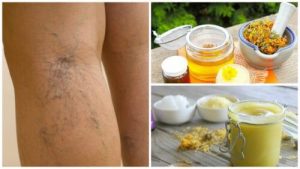 Behandl åreknuder og karsprængninger med denne arnica salve