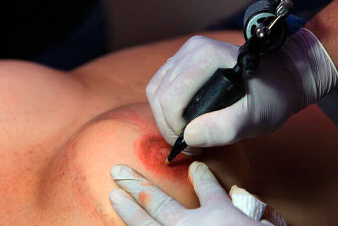 Kvinde der faar tatoveret ny brystvorte