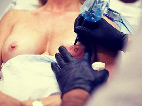 Kvinde der faar tatoveret ny brystvorte - kvindelighed efter brystkraeft