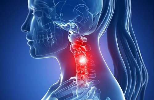 Symptomer på cervikal spondylose og naturlig behandling