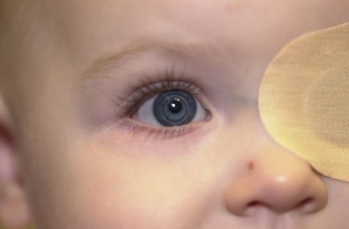 En baby med klap for det ene oeje
