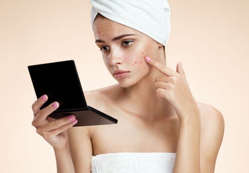 Cystisk akne: 6 naturlige midler