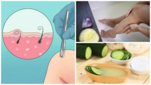 5 naturlige måder til at slippe af med indgroede hår