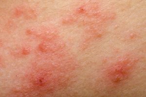 Opdag disse 9 naturlige midler mod rosacea