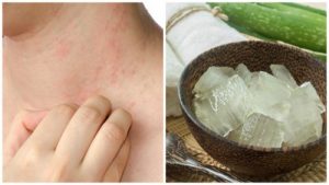 7 løsninger til at finde lindring mod varmeallergier