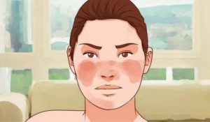 7 midler til at kontrollere lupus