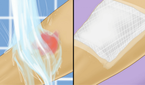 Førstehjælp til forbrændinger og skoldninger