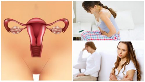 Syv ting du skal vide om polycystisk ovariesyndrom