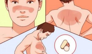 Det skal du vide om den autoimmune lupus sygdom