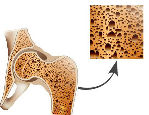 slidgigt og osteoporose er begge trælse sygdomme.