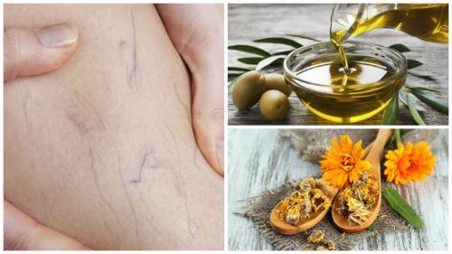 Sådan kan du slippe af med åreknuder med olivenolie og morgenfrue