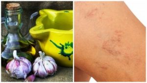 Behandl åreknuder naturligt med olivenolie og hvidløg