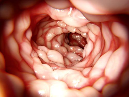 Hvad du skal vide omkring behandling af crohns sygdom