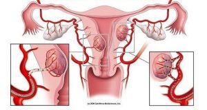 7 advarselstegn på fibromer du bør kende til