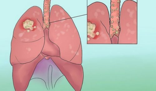 8 chokerende tegn på lungekræft du ikke bør ignorere